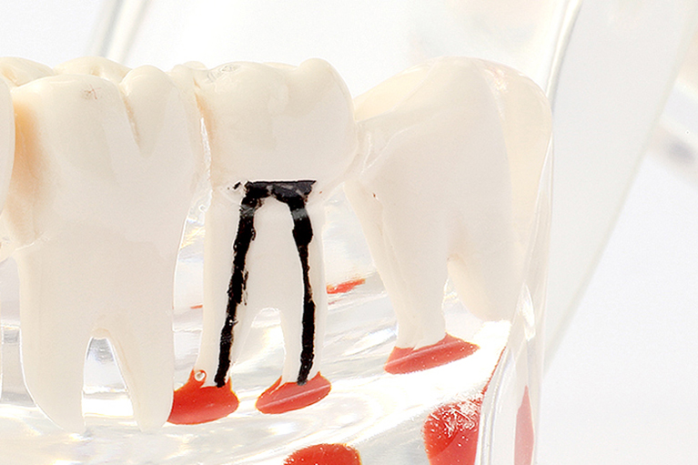 歯の根まで進行した虫歯には「根管治療」を
